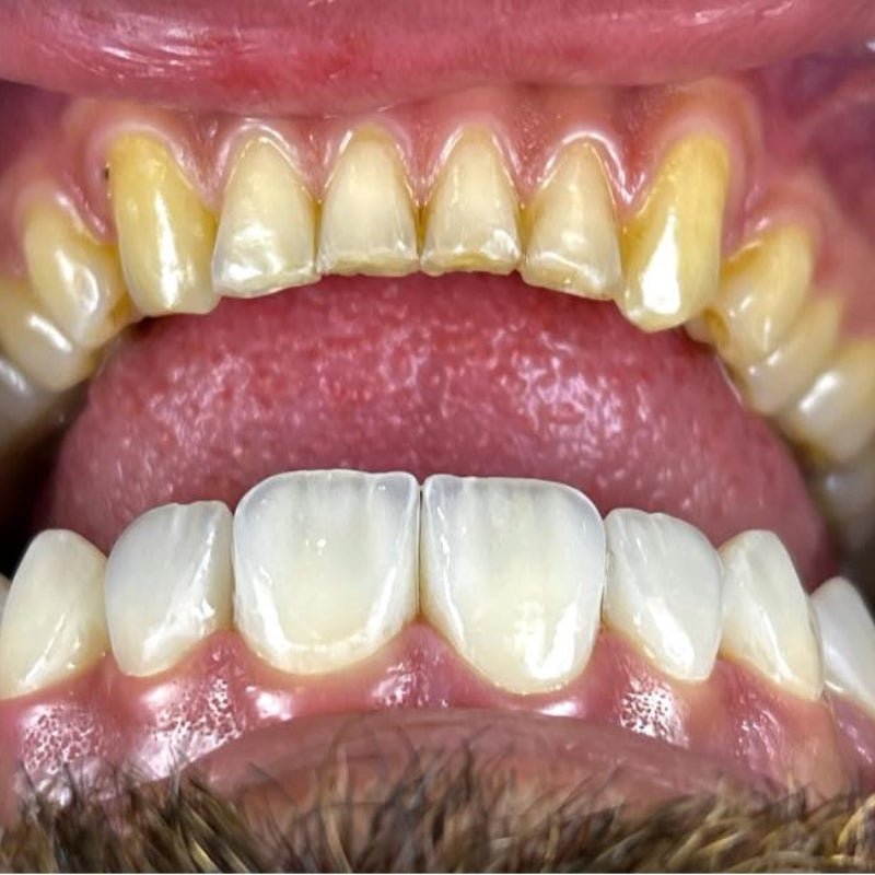 Lithium disilicate knowledge - CeraDirect