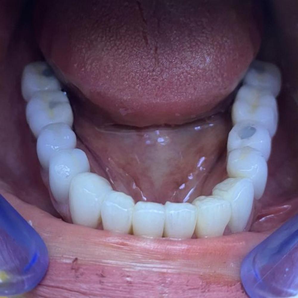 What? Can my oxidation crown be carcinogenic? - CeraDirect