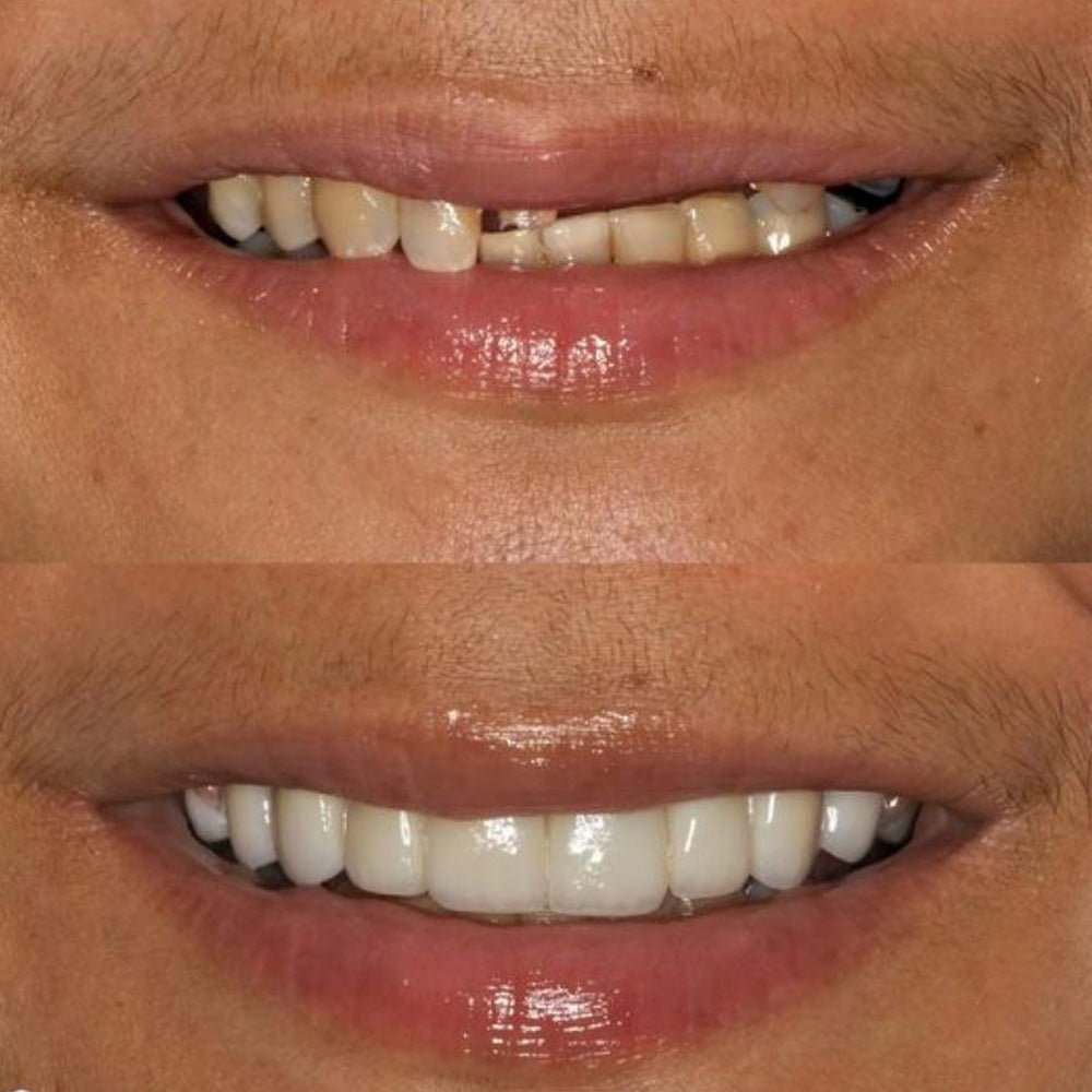 Why do dentists recommend that you make full porcelain teeth? - CeraDirect