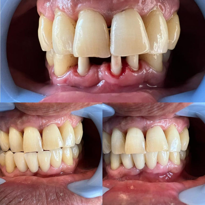 The Advancement of Dentistry through Dental Zirconia Blocks: Revolutionizing Prosthetic Fabrication