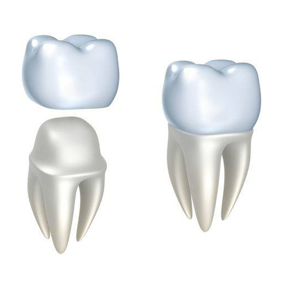 What to Know About a Temporary Dental Crown