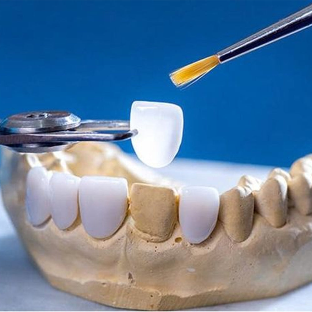 Clinical application of lithium disilicate cast porcelain dental ...