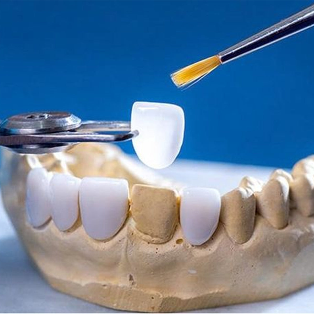Clinical application of lithium disilicate cast porcelain dental veneers in the restoration of heavily worn teeth