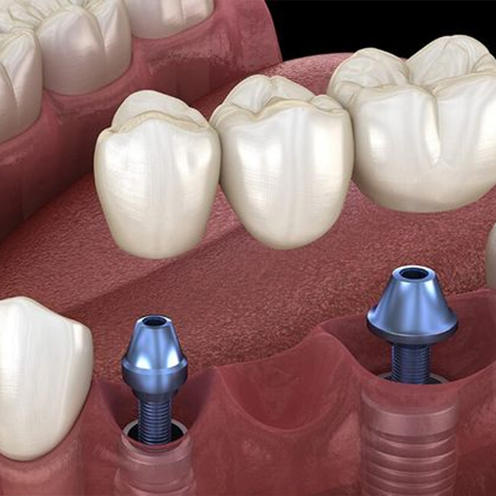 What are the effects of occlusal thickness design on the fracture resistance of zirconia restored root canal crowns?