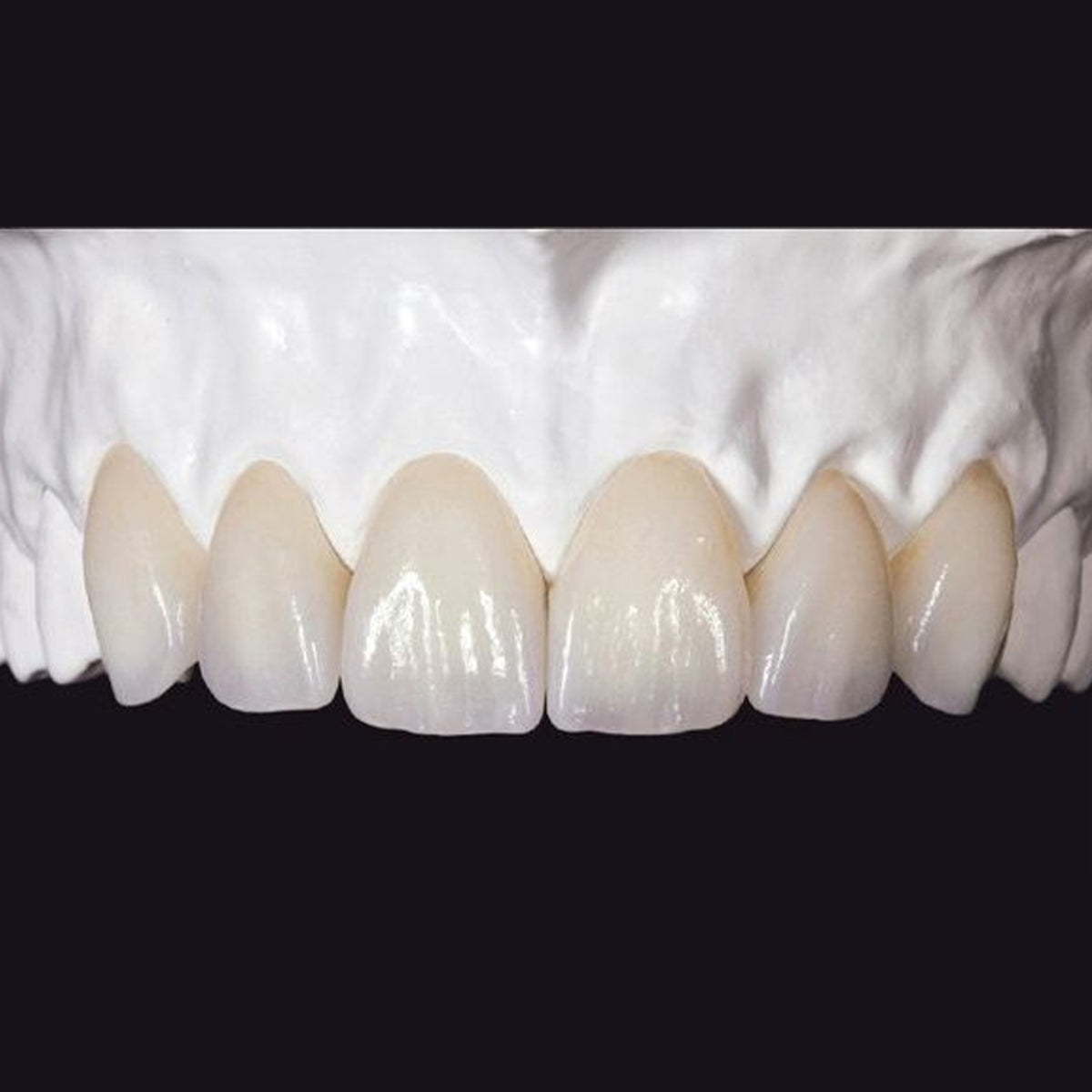 Analysis of indications for zirconia vs glass ceramics