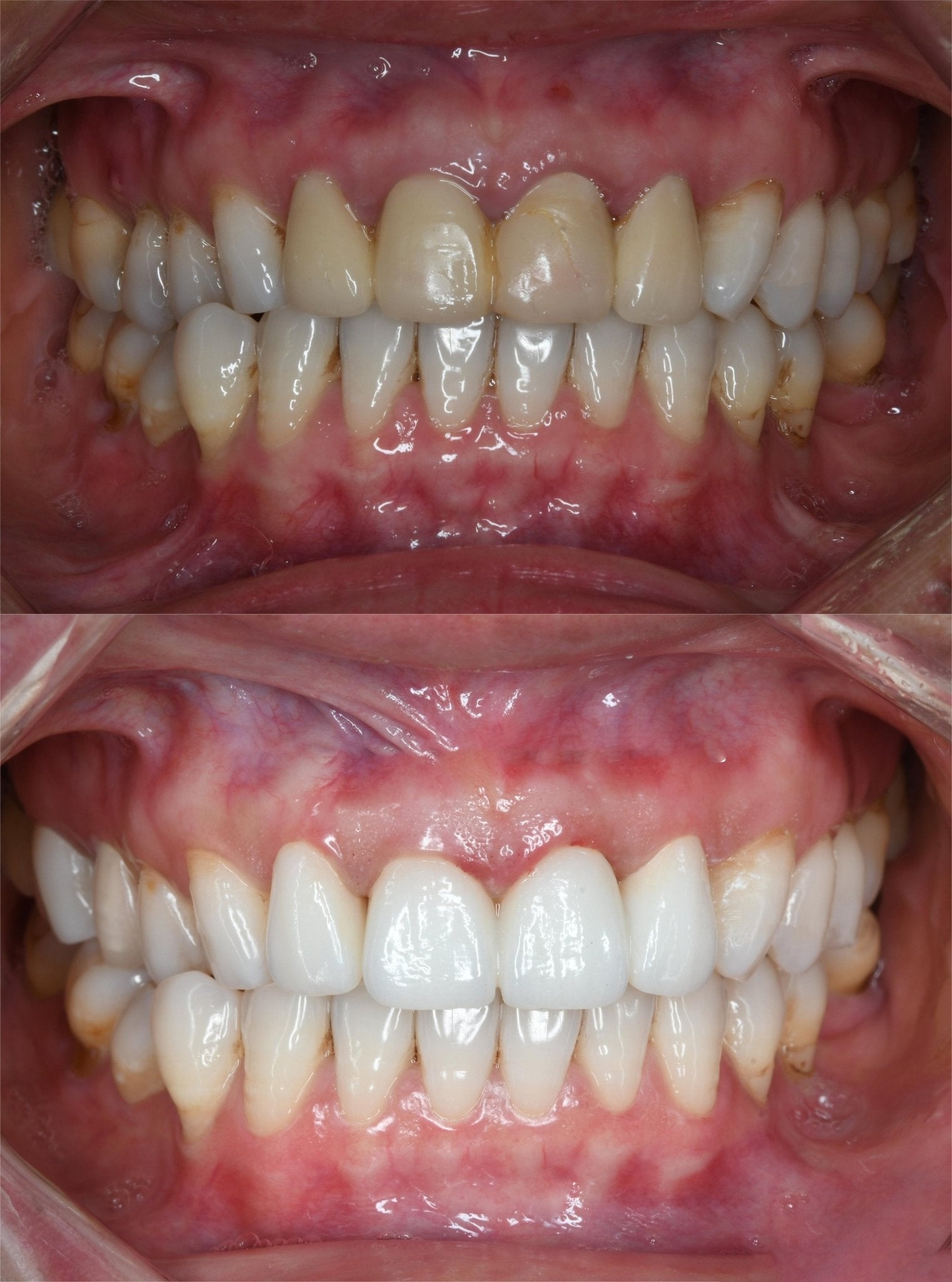 A few points for attention in dental aesthetic restoration - CeraDirect