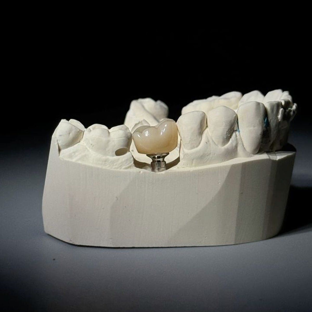 Efficacy evaluation of zirconia crown on primary molars with caries defects