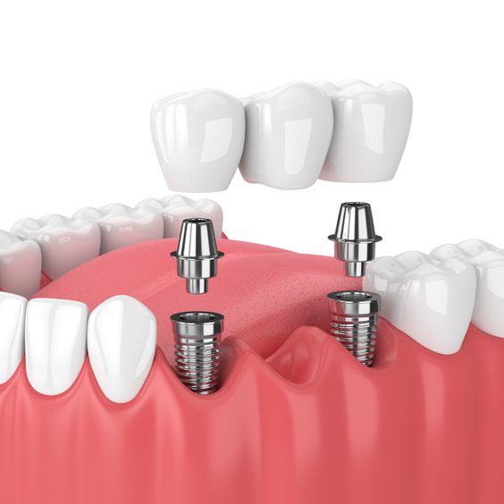 Causes of pain after dental implant surgery - CeraDirect