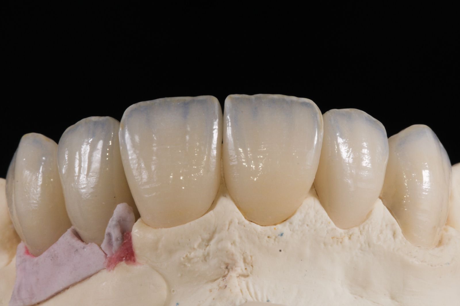 Factors influencing the bond strength of additively manufactured crown materials in dentistry - CeraDirect