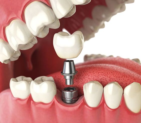 Research progress on the application of surgical template and dynamic navigation system in implant dentistry - CeraDirect