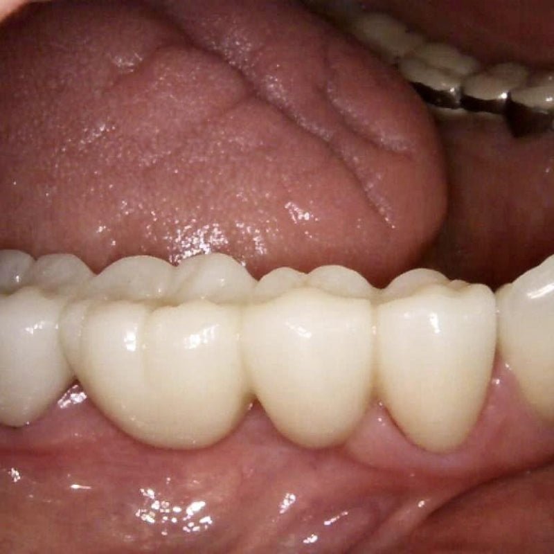 The Benefits of CAD/CAM Blocks in the Field of Dentistry