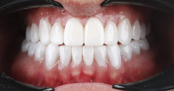 The Most Popular Choice: Why Lithium Disilicate Teeth Reign Supreme - CeraDirect